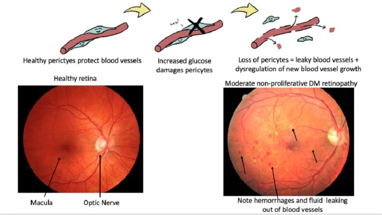 Eye Test Cost For Diabetes Eye Test Cost For Diabetes